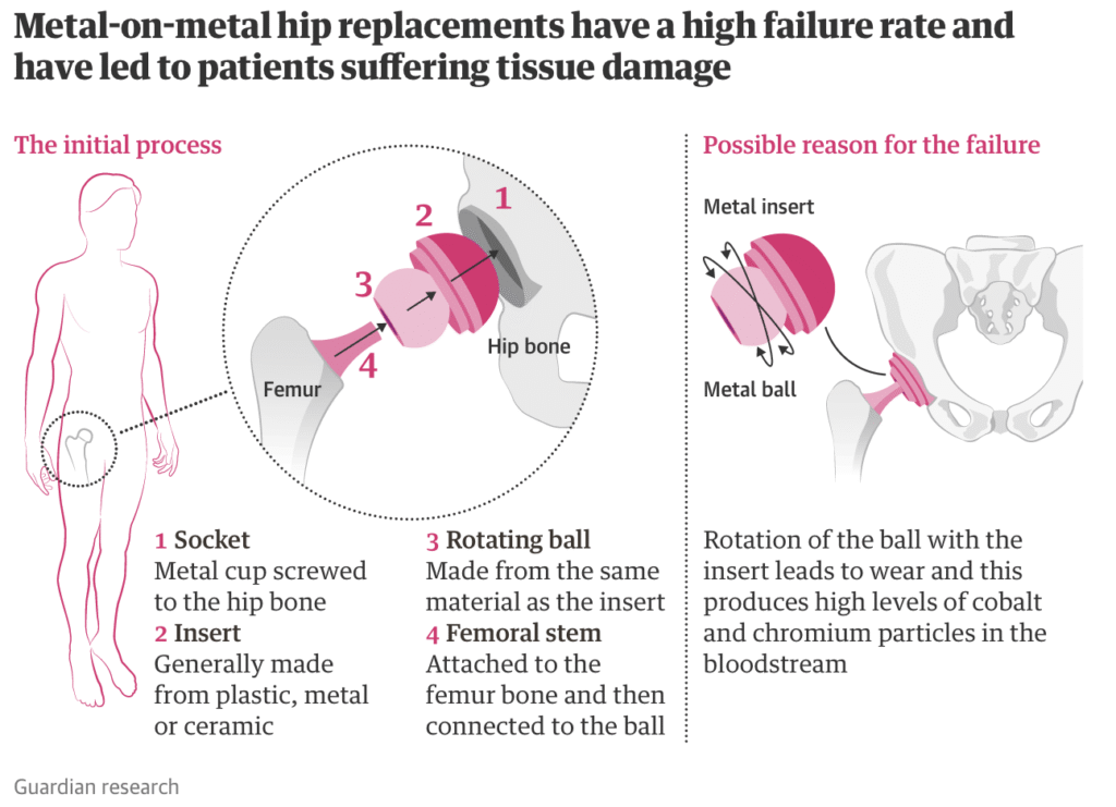 Hip Exploded Diagram 1