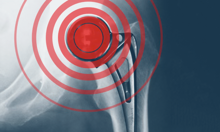 Firm pays out to NHS over defective hip replacements
